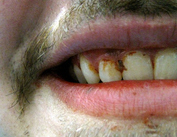 Nothing a good teeth brushing couldn't fix